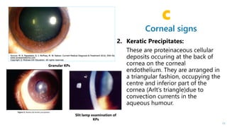 Corneal signs
C
11
Granular KPs
Slit lamp examination of
KPs
 