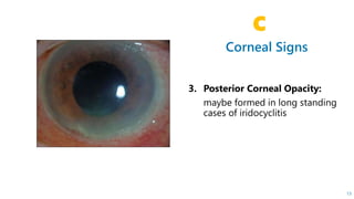 Corneal Signs
C
13
 