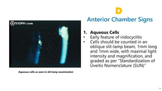Anterior Chamber Signs
D
14
Aqueous cells as seen in slit lamp examination
 