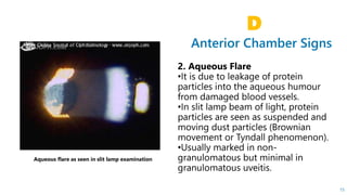 Anterior Chamber Signs
D
15
Aqueous flare as seen in slit lamp examination
 