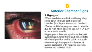 Anterior Chamber Signs
D
17
 