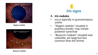 Iris signs
E
20
Koppe’s nodules
Busacca’s nodules
 