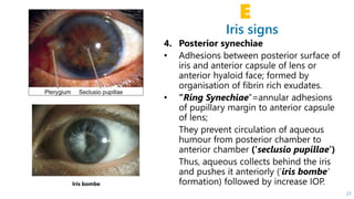 Iris signs
E
21
Iris bombe
 