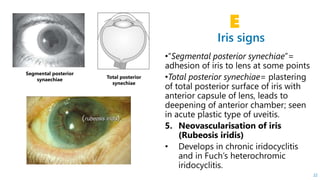 Iris signs
E
22
Segmental posterior
synaechiae Total posterior
synechiae
 
