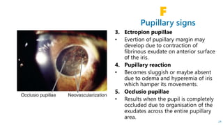 Pupillary signs
F
24
 