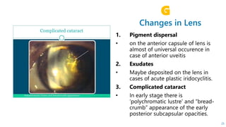 Changes in Lens
G
25
 