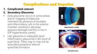 Complications and Sequelae
27
Hypertensive uveitis
Late glaucoma
 