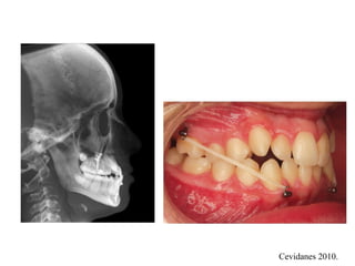 Xbite Tendency Anterior X bite.pptx in orthodontics//// | PPTX