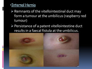 •Internal Hernia
 Remnants of the vitellointestinal duct may
form a tumour at the umbilicus (raspberry red
tumour)
 Persistance of a patent vitellointestine duct
results in a faecal fistula at the umbilicus.
 