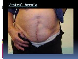 Ventral hernia
 Supraumbilical median incisions through
the linea alba have various advantages
as being
1) Bloodless
2) Safety to muscles & nerves
However, It tends to leave a
postoperative weakness through which
a ventral hernia may develop.
 