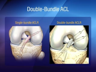 Anterolateral Ligament (ALL) | PDF