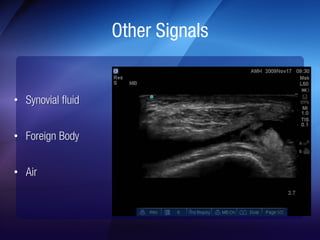 Anterolateral Ligament (ALL) Slide 22