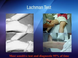 Lachman Test 
Most sensitive test for ACL instability 
Diagnostic 95% of time 
 