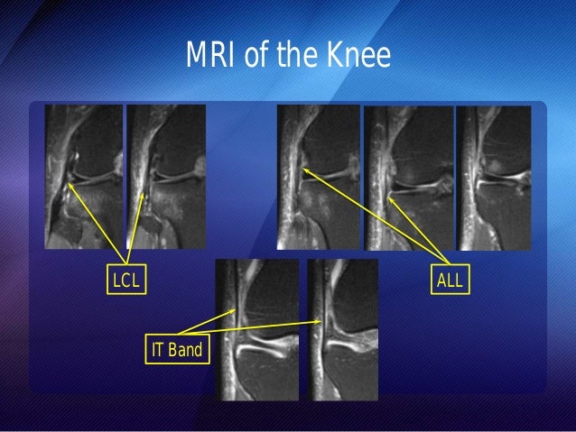 View Ligaments Of The Knee Mri PNG