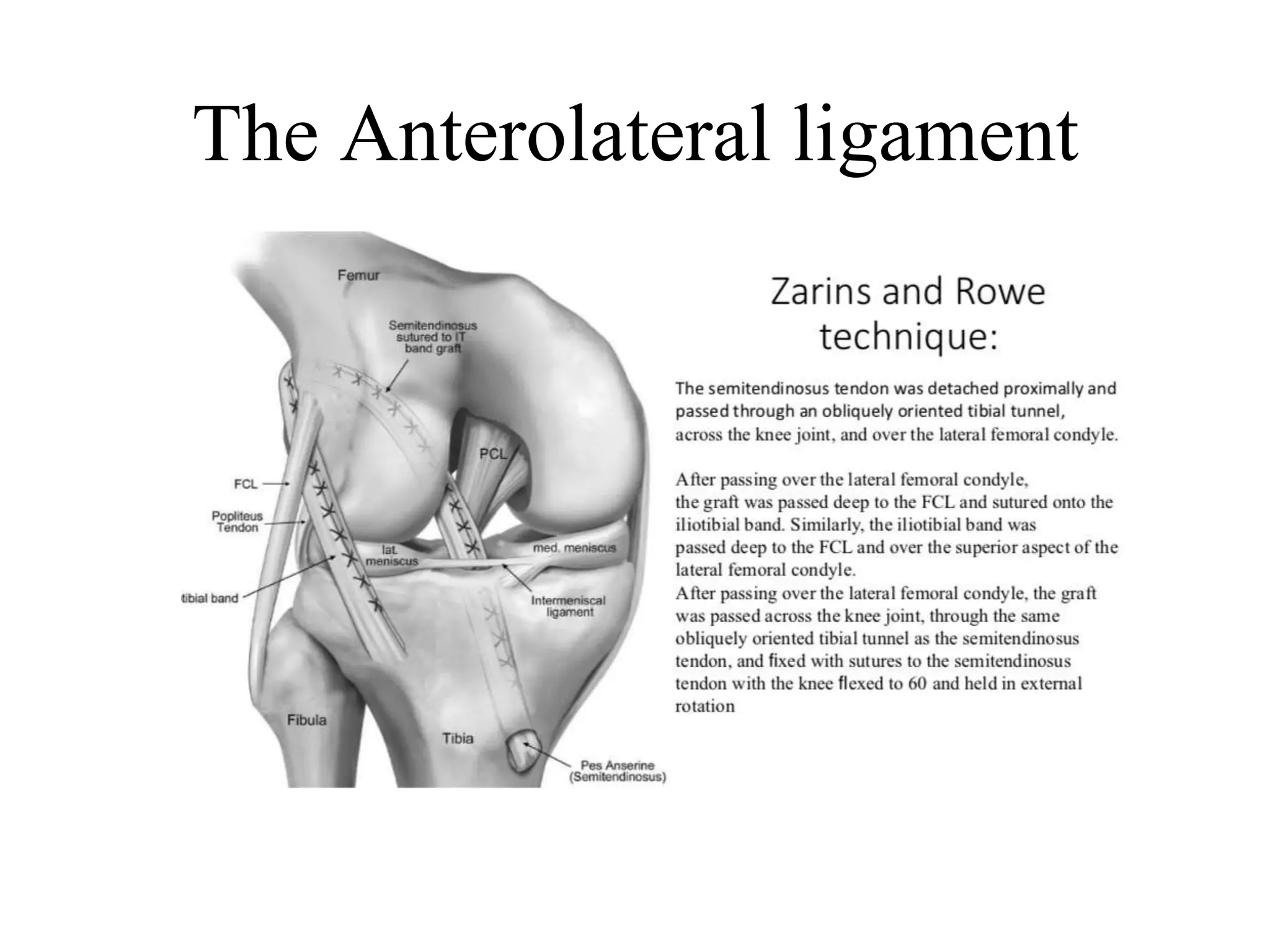 The Antero-lateral ligament 