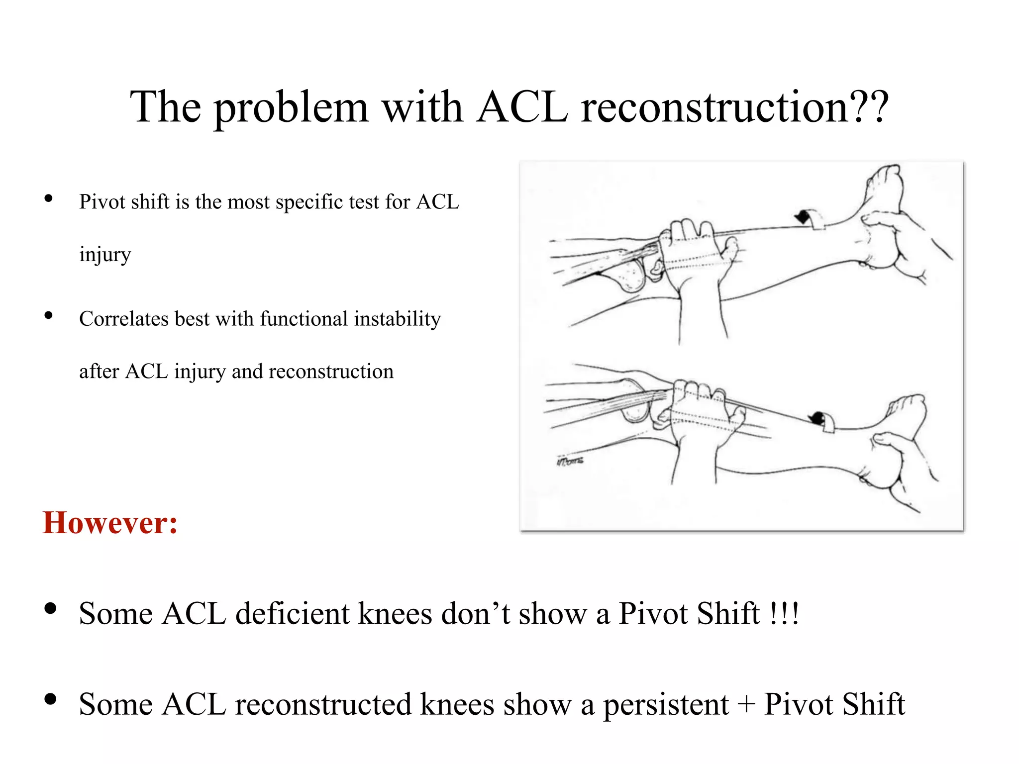 The Antero-lateral ligament 