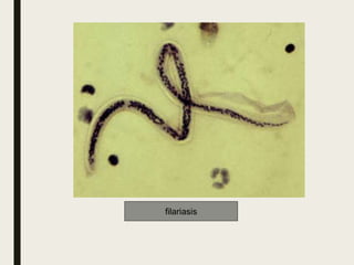 filariasis
 