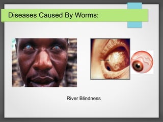 Diseases Caused By Worms:
River Blindness
 