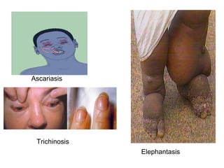 AscariasisAscariasis
Elephantasis
Trichinosis
 