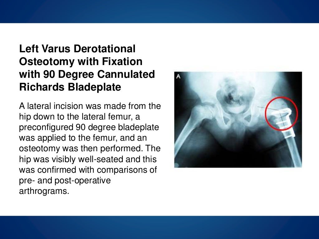 Legg calve perthes disease physiopedia picture