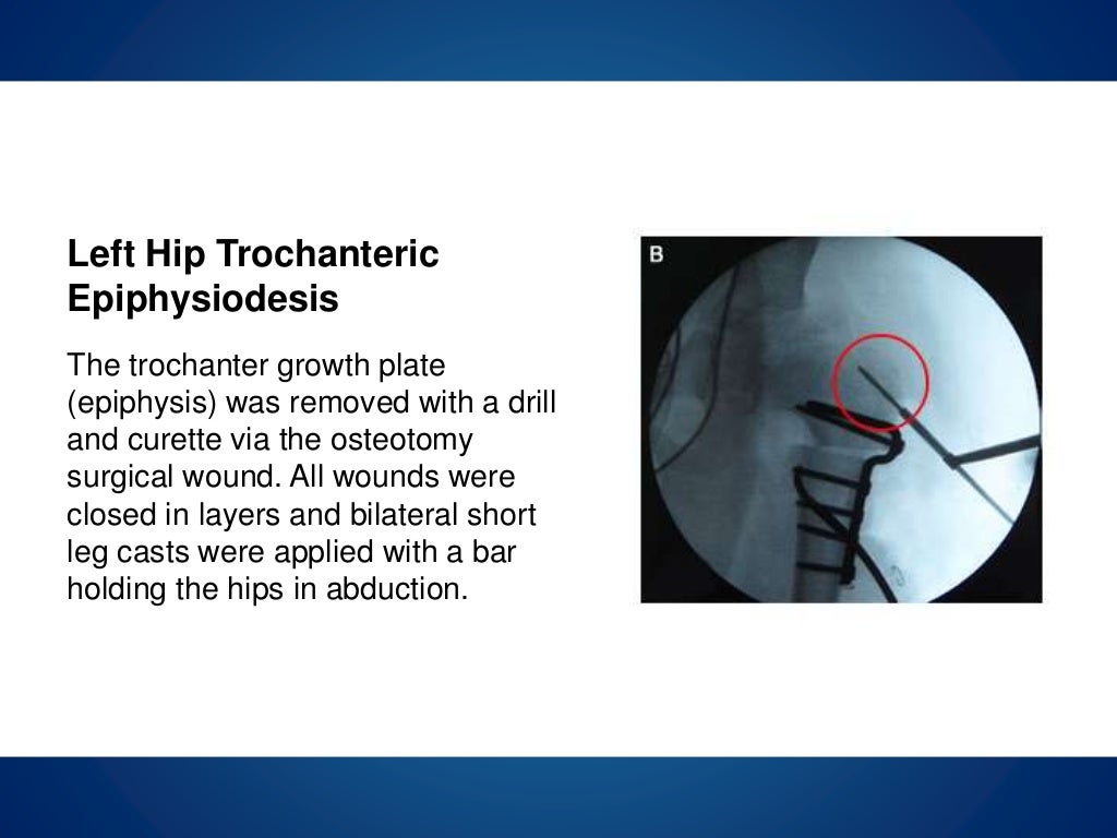 Legg calve perthes disease case study 07 image
