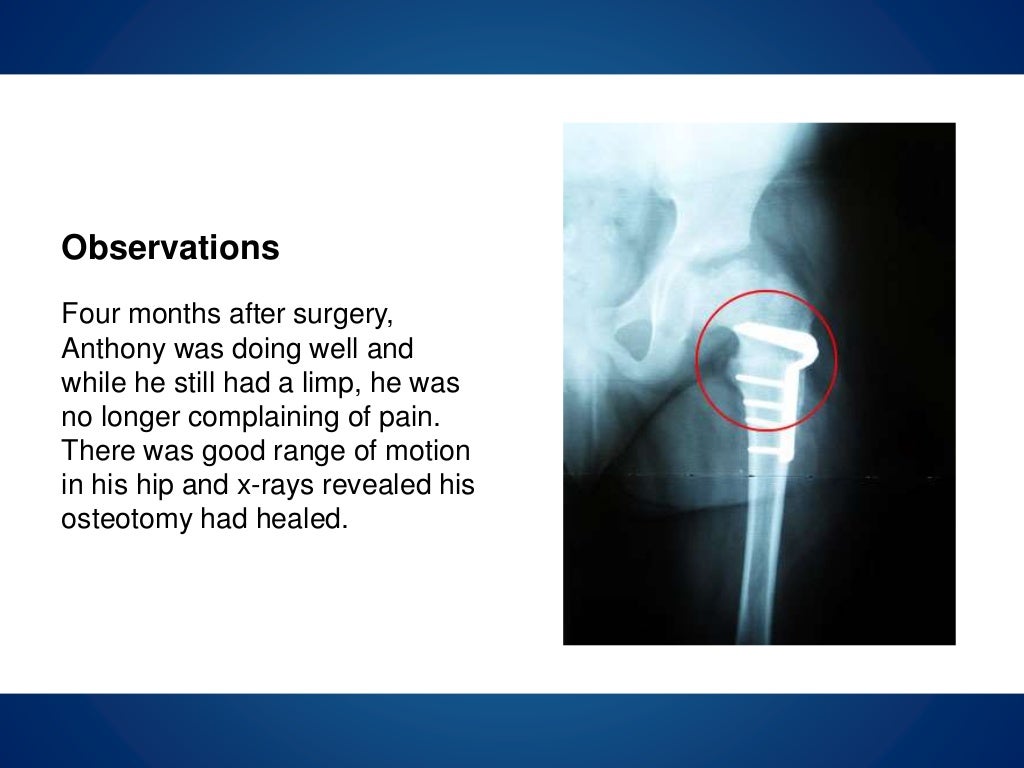 Perthes disease presentation image