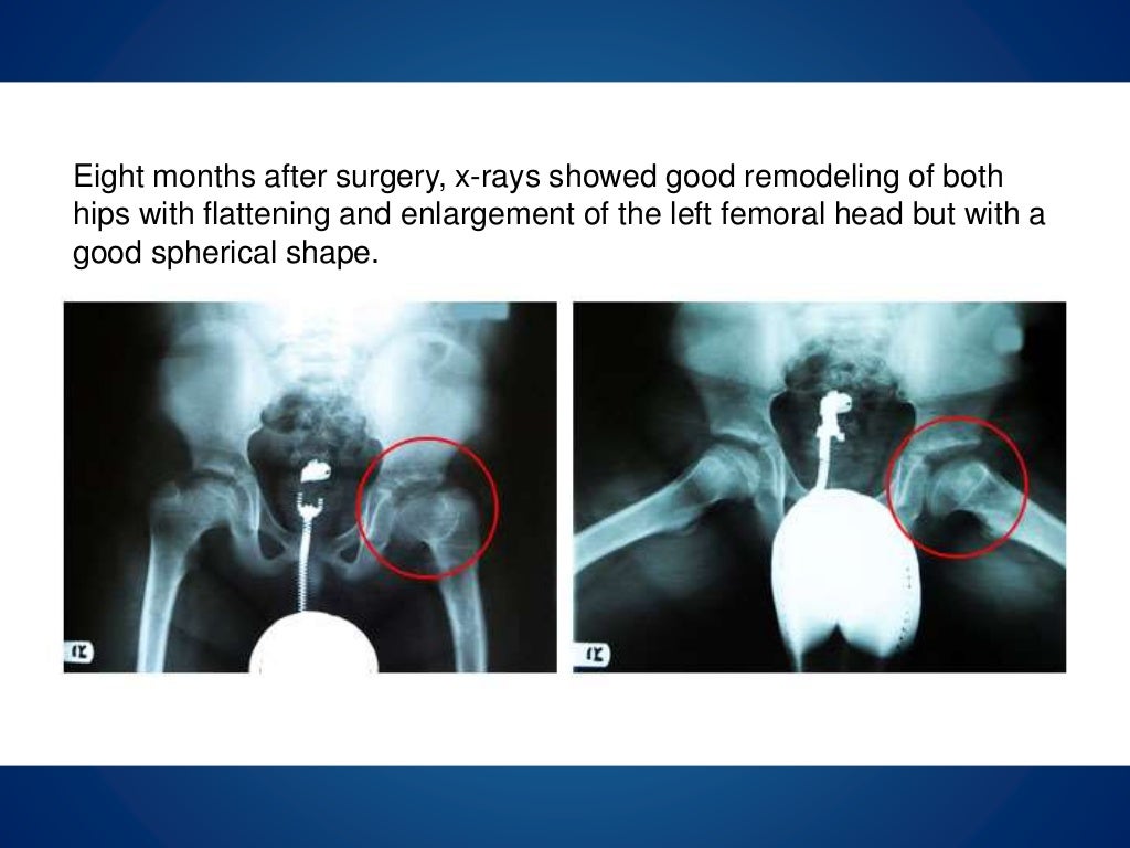 Legg calve perthes disease stages image