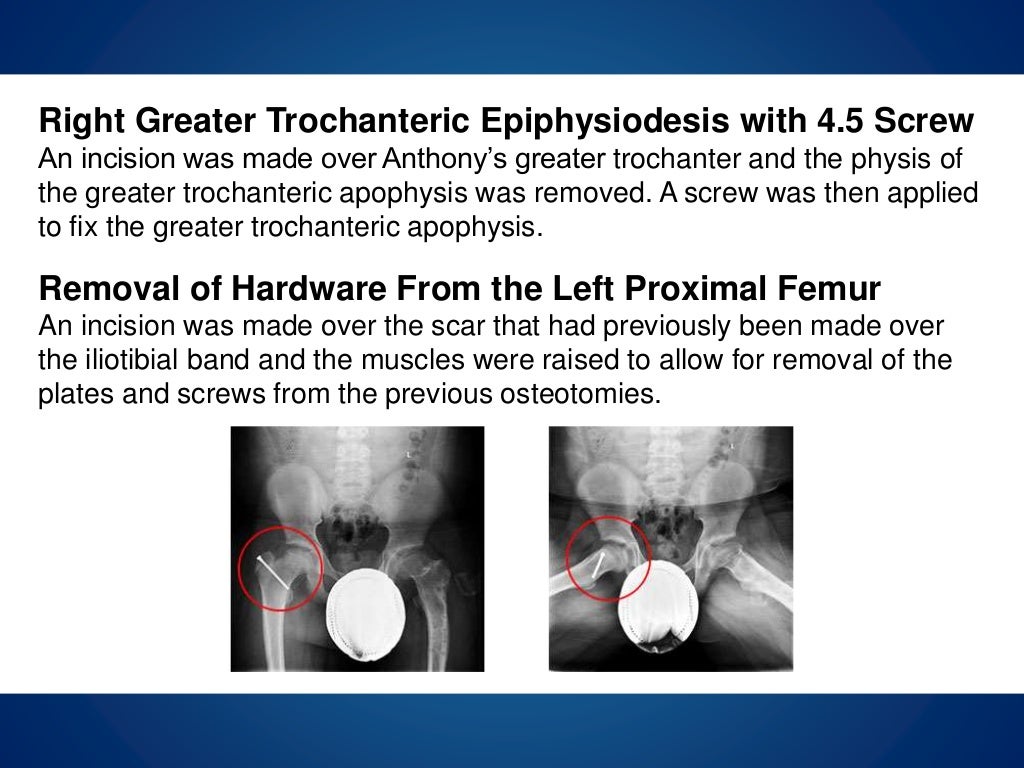 Legg calve perthes disease case study image