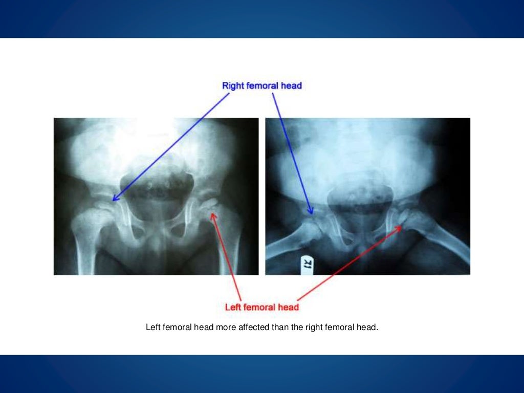 Perthes case study 03 picture