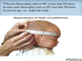 The term Macrocephaly refers to OFC of more than 2SD above 
the mean while Microcephaly refers to OFC more than 3SD below 
the mean for age , sex , height and weight. 
24 
 