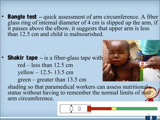 • Bangle test – quick assessment of arm circumference. A fiber 
glass ring of internal diameter of 4 cm is slipped up the arm, if 
it passes above the elbow, it suggests that upper arm is less 
than 12.5 cm and child is malnourished. 
• Shakir tape – is a fiber-glass tape with 
red – less than 12.5 cm 
yellow – 12.5- 13.5 cm 
green – greater than 13.5 cm 
shading so that paramedical workers can assess nutritional 
status without having to remember the normal limits of mid 
arm circumference. 
31 
 