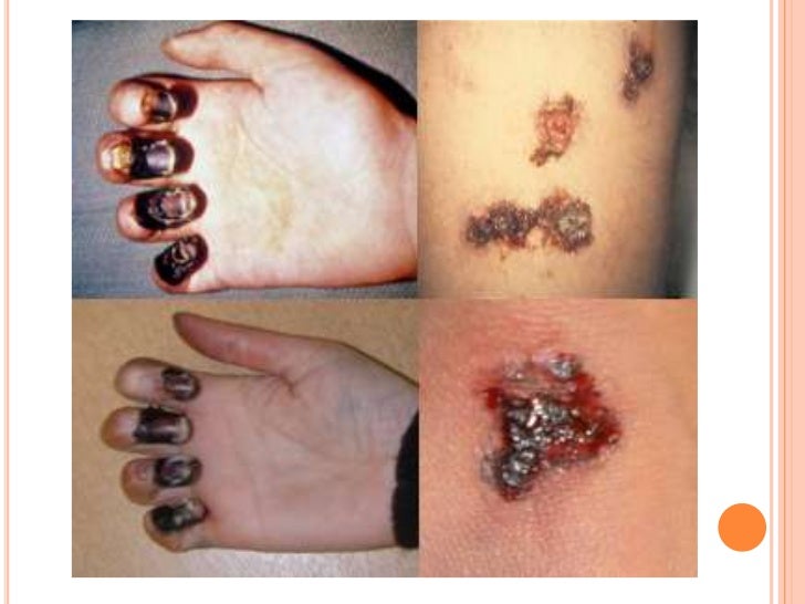 Hasil gambar untuk gastrointestinal anthrax