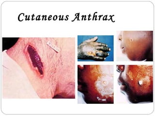 Cutaneous Anthrax
 