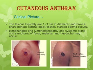 Cutaneous Anthrax
     Clinical Picture :-
 The lesions typically are 1–3 cm in diameter and have a
  characteristic central black eschar. Marked edema occurs.
 Lymphangitis and lymphadenopathy and systemic signs
  and symptoms of fever, malaise, and headache may
  occur.
 