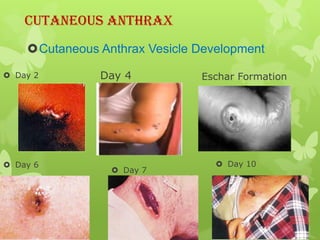 Cutaneous Anthrax
    Cutaneous Anthrax Vesicle Development

 Day 2        Day 4           Eschar Formation




 Day 6                            Day 10
                  Day 7
 