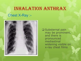 Inhalation Anthrax
Chest X-Ray :-


                  Substernal pain
                   may be prominent,
                   and there is
                   pronounced
                   mediastinal
                   widening visible on
                   x-ray chest films
 
