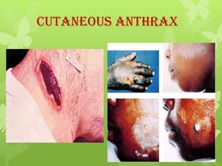 Inhalation Anthrax
   Preview:-
 Incubation period: 1-7 days (range up to
  43 days).

 Infection occure by inhalation o...