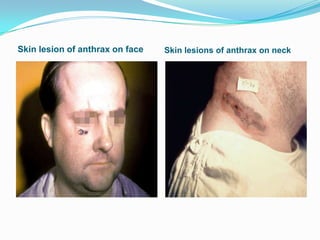 Skin lesion of anthrax on face

Skin lesions of anthrax on neck

 