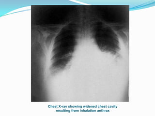 Chest X-ray showing widened chest cavity
resulting from inhalation anthrax

 