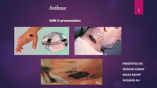 Anthrax
CHN ii presentation
PRESENTED BY;
NOMAN ASMAT
MAAZ RAHAT
HUSSAIN ALI
1
 