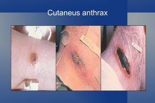 Anthrax a biological weapon 1915 - German agents injected horses, mules, and cattle with anthrax during WWI. This was the  first  recorded use of anthrax as a  biological   weapon . 