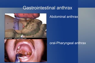Anthrax cases 2001 22 cases 
