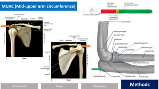 Introduction Methods
Objectives
Goals Methods
MUAC (Mid-upper arm circumference)
 