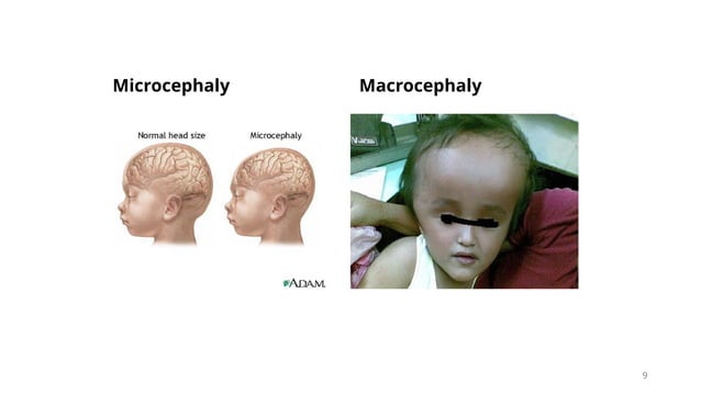 Anthropometric measurements in children (to assess nutrition).pptx ...