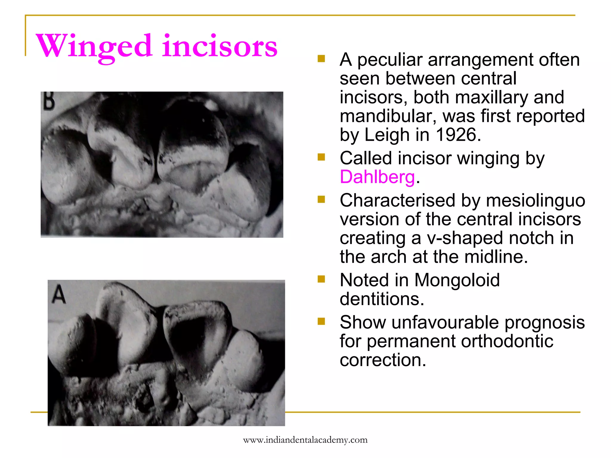 Winged incisors









A peculiar arrangement often
seen between central
incisors, both maxillary and
mandibular, was first reported
by Leigh in 1926.
Called incisor winging by
Dahlberg.
Characterised by mesiolinguo
version of the central incisors
creating a v-shaped notch in
the arch at the midline.
Noted in Mongoloid
dentitions.
Show unfavourable prognosis
for permanent orthodontic
correction.

www.indiandentalacademy.com

 