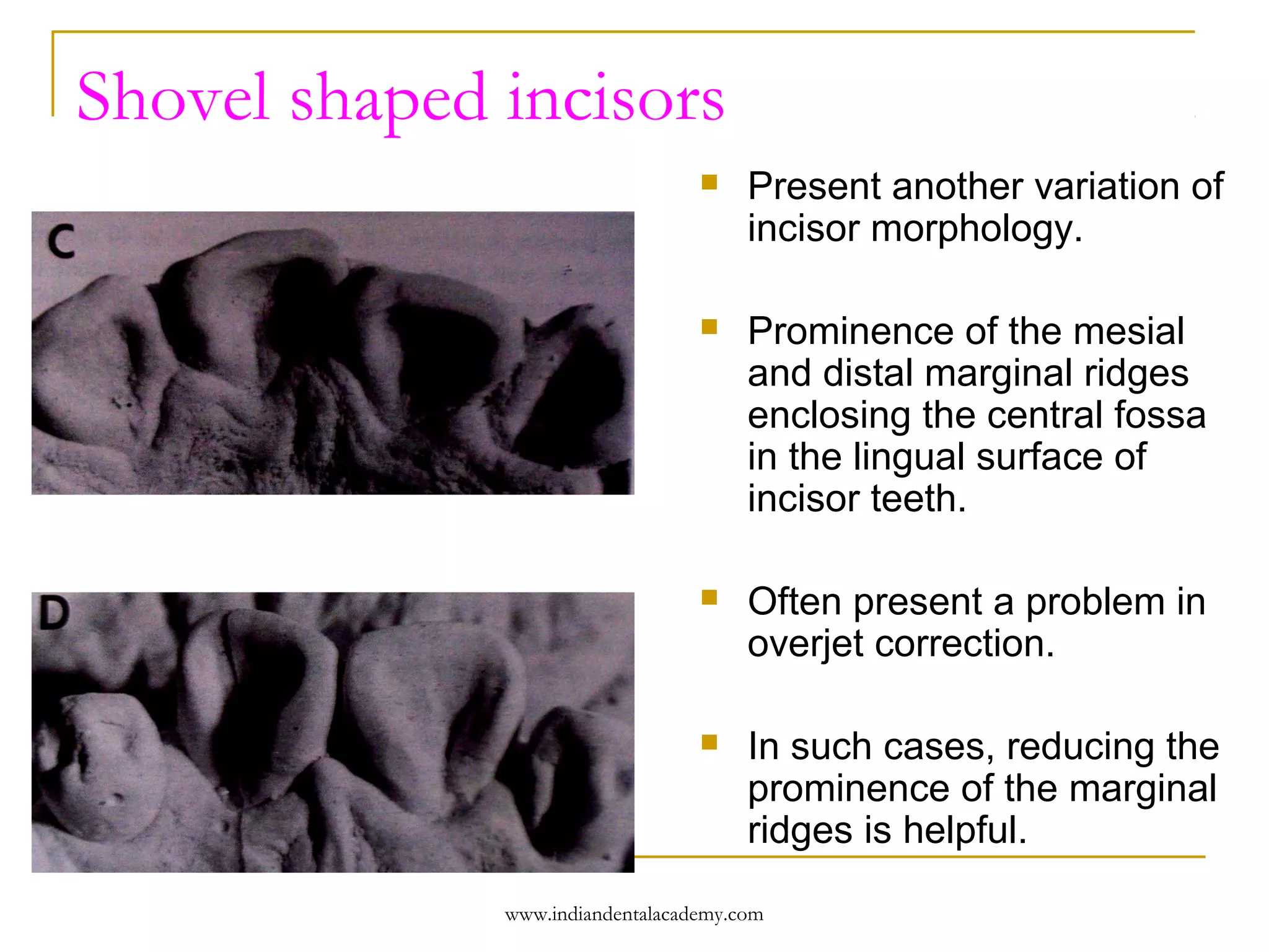 Shovel shaped incisors


Present another variation of
incisor morphology.



Prominence of the mesial
and distal marginal ridges
enclosing the central fossa
in the lingual surface of
incisor teeth.



Often present a problem in
overjet correction.



In such cases, reducing the
prominence of the marginal
ridges is helpful.

www.indiandentalacademy.com

 