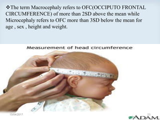 The term Macrocephaly refers to OFC(OCCIPUTO FRONTAL
CIRCUMFERENCE) of more than 2SD above the mean while
Microcephaly refers to OFC more than 3SD below the mean for
age , sex , height and weight.
15/04/2017 23
 