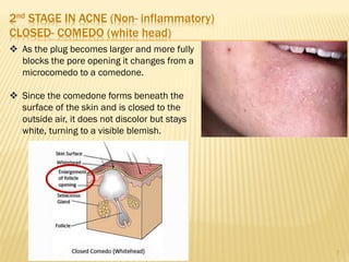 Plug Discolor Anti-acne Preparations | PDF