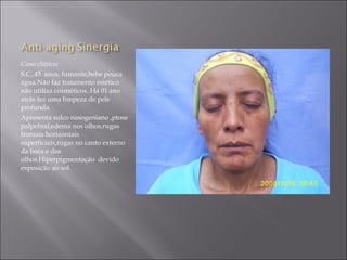 Caso clinico:
S.C.,45 anos, fumante,bebe pouca
água.Não faz tratamento estético
não utiliza cosméticos..Há 01 ano
atrás fez uma limpeza de pele
profunda.
Apresenta sulco nasogeniano ,ptose
palpebral,edema nos olhos,rugas
frontais horizontais
superficiais,rugas no canto externo
da boca e dos
olhos.Hiperpigmentação devido
exposição ao sol.
 