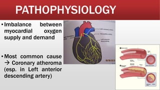 PATHOPHYSIOLOGY
▪Imbalance between
myocardial oxygen
supply and demand
▪Most common cause
 Coronary atheroma
(esp. in Left anterior
descending artery)
 
